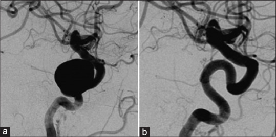 Periprocedural management of patients presenting for neurointerventional procedures using flow diverters for complex intracranial aneurysms: An anesthetist's perspective - A narrative review.