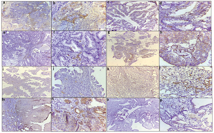 Evaluation of the diagnostic utility of MCAM-1 (CD146) in a group of common gynecological cancers: A case-control study.