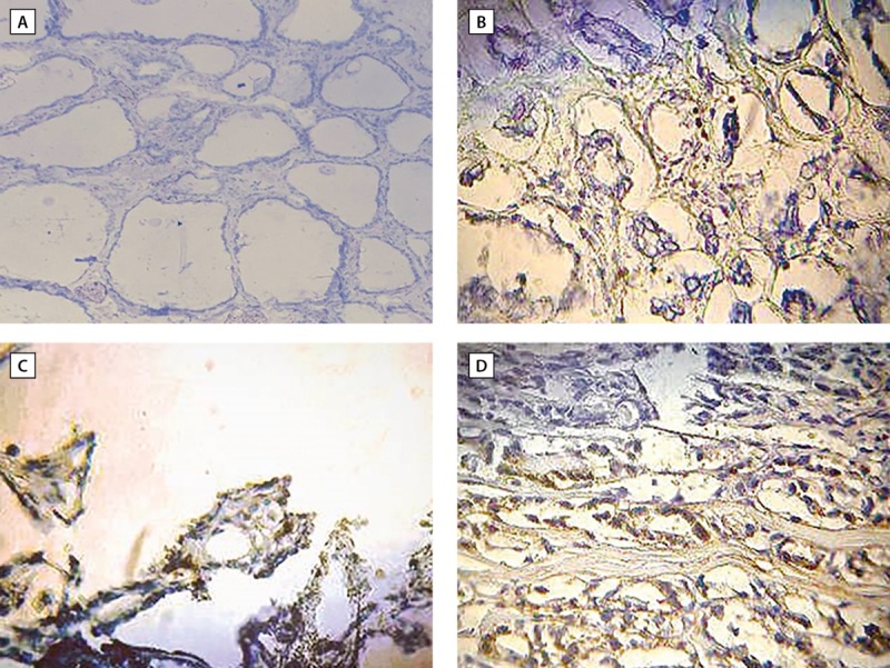 KI-67 as a predictive indicator of papillary thyroid cancer in Iraqi patients.