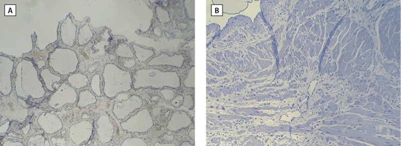 KI-67 as a predictive indicator of papillary thyroid cancer in Iraqi patients.