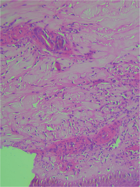 Ibrutinib-Associated Leukocytoclastic Vasculitis in a Patient with Chronic Lymphocytic Leukemia.