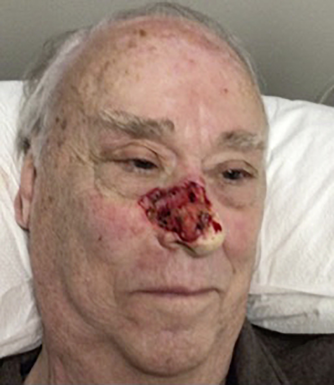 Repair of a Large Nasal Ala and Medial Cheek Defect: Case Report.