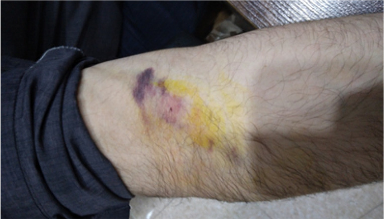 A Case Report of Prolonged Hemorrhage Following Traditional Phlebotomy (Fasd).