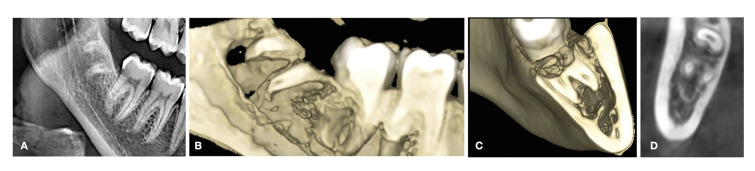 Coronectomy of impacted mandibular third molars: a clinical and radiological retrospective case series study with 2-9 years of follow-up.
