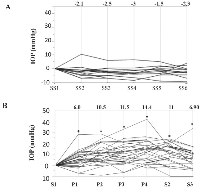Increase in Intraoperative Intraocular Pressure in the Prone Position.