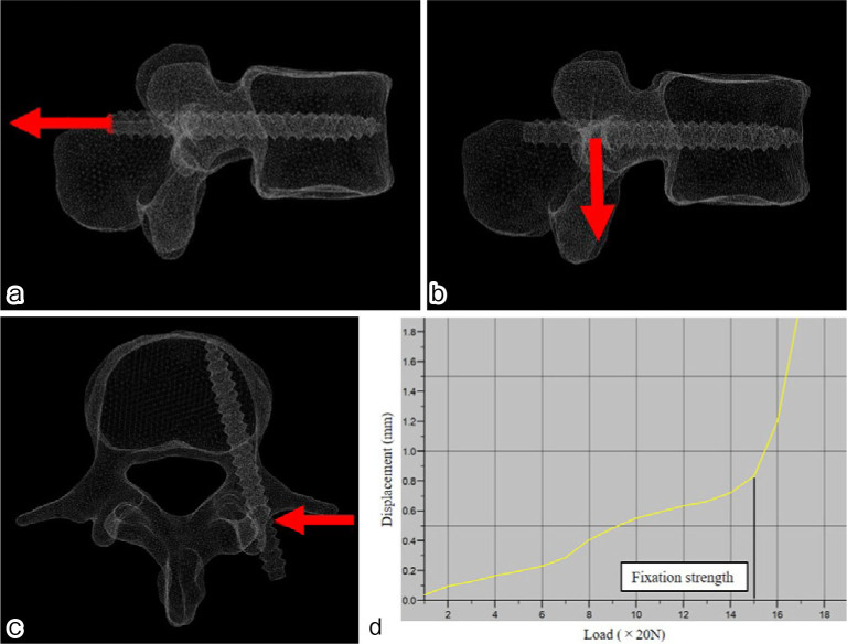 A Bicortical Pedicle Screw in the Cephalad Trajectory Is the Best Option for the Fixation of an Osteoporotic Vertebra: A Finite Element Study.