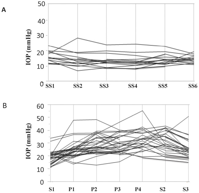 Increase in Intraoperative Intraocular Pressure in the Prone Position.