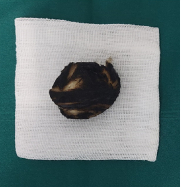 A Case Report of Prolonged Hemorrhage Following Traditional Phlebotomy (Fasd).