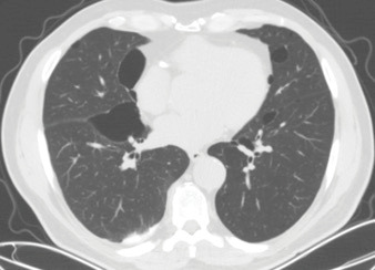 Birt-Hogg-Dubé syndrome with novel FLCN gene mutations and different clinical presentations: Case series.
