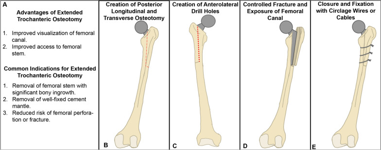 The feasibility of a novel 3D-Printed patient specific cutting guide for extended trochanteric osteotomies.