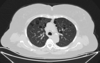 Birt-Hogg-Dubé syndrome with novel FLCN gene mutations and different clinical presentations: Case series.