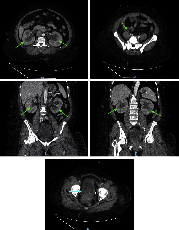 Case of Circulating Tumor Cells Discovered in Extensive Deep Venous Thrombosis in a Patient with Known Urothelial Carcinoma.