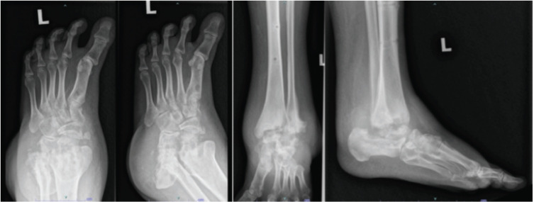 Effectiveness of Pamidronate Infusion in the Treatment of Charcot Arthropathy.