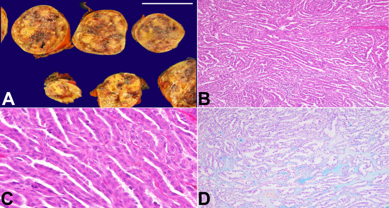 Papillary renal cell carcinoma with extensive spindle cell foci: mimicker of mucinous tubular and spindle cell carcinoma.