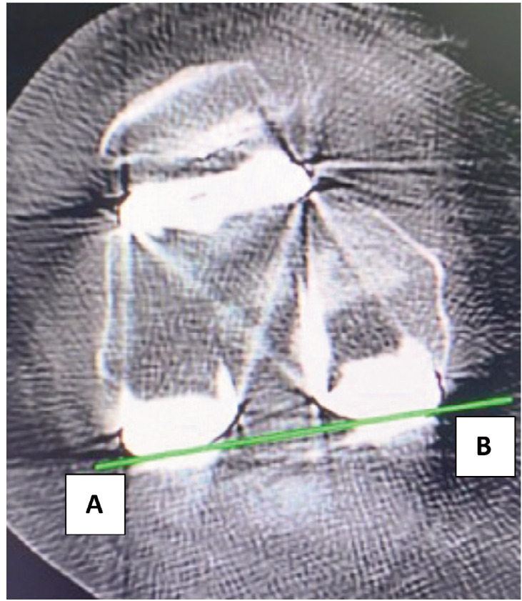 Accuracy of Femoral Component External Rotation with all Burr Robotic Assisted Total Knee Arthroplasty.