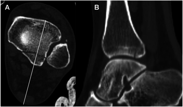 Percutaneous posterior to anterior screw fixation through achilles tendon for posterior malleolus fractures: technique description and case series.