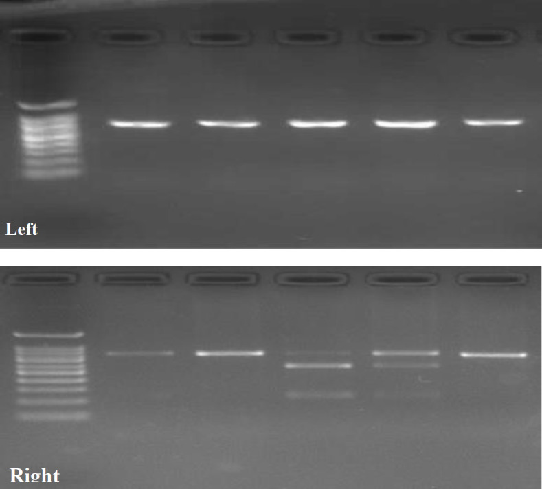 Association between Vitamin D Receptor Polymorphism and Susceptibility to Oral Lichen Planus and Oral Squamous Cell Carcinoma.
