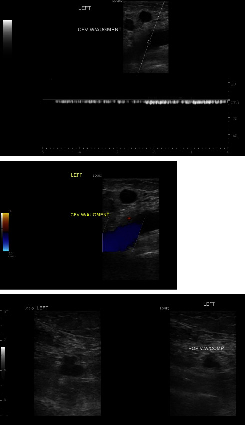 Case of Circulating Tumor Cells Discovered in Extensive Deep Venous Thrombosis in a Patient with Known Urothelial Carcinoma.
