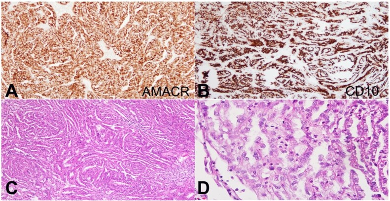 Papillary renal cell carcinoma with extensive spindle cell foci: mimicker of mucinous tubular and spindle cell carcinoma.