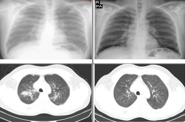 Results of omalizumab treatment in chronic eosinophilic pneumonia: Real-life data.