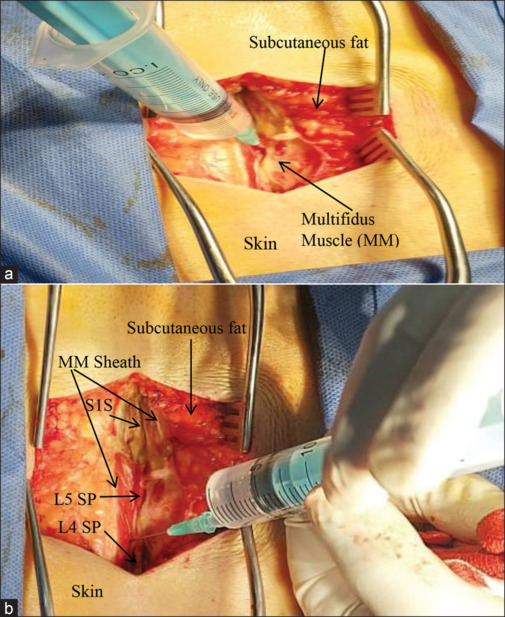 Retrolaminar block for opioid-free anaesthesia and enhanced recovery after posterior lumbar discectomy: A randomised controlled study.