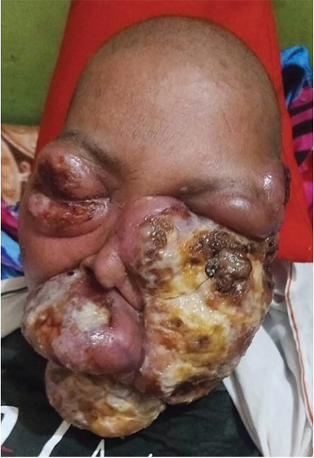 Advanced Cutaneous Peripheral T-cell Lymphoma-Not Otherwise Specified with Extensive Ulceronecrotic Dyschromic Plaques and Poor Outcome