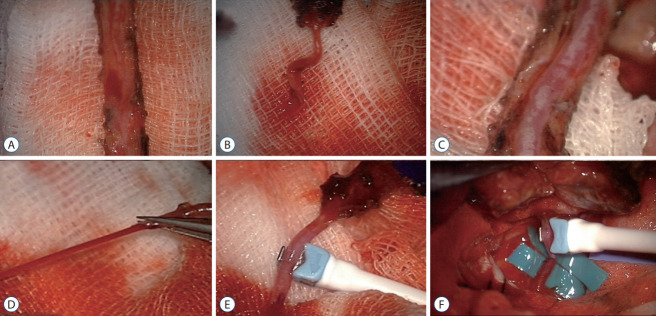 Assessing the Adequacy of Superficial Temporal Artery Blood Flow in Korean Patients Undergoing STA-MCA Anastomosis.