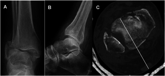 Percutaneous posterior to anterior screw fixation through achilles tendon for posterior malleolus fractures: technique description and case series.