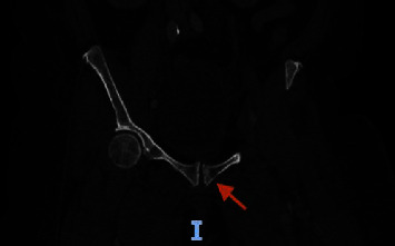 Case of Circulating Tumor Cells Discovered in Extensive Deep Venous Thrombosis in a Patient with Known Urothelial Carcinoma.