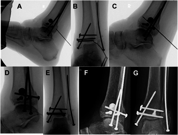 Percutaneous posterior to anterior screw fixation through achilles tendon for posterior malleolus fractures: technique description and case series.