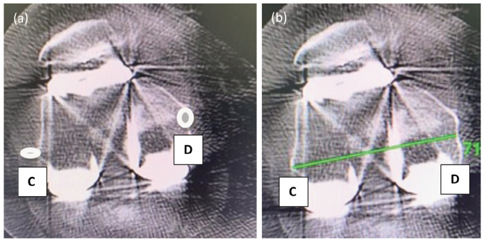 Accuracy of Femoral Component External Rotation with all Burr Robotic Assisted Total Knee Arthroplasty.