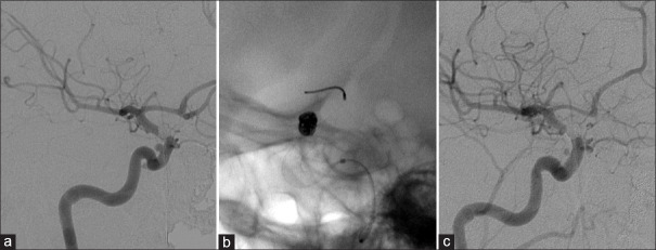 Overt nickel and cobalt hypersensitivity after pipeline embolization device placement: A case report.
