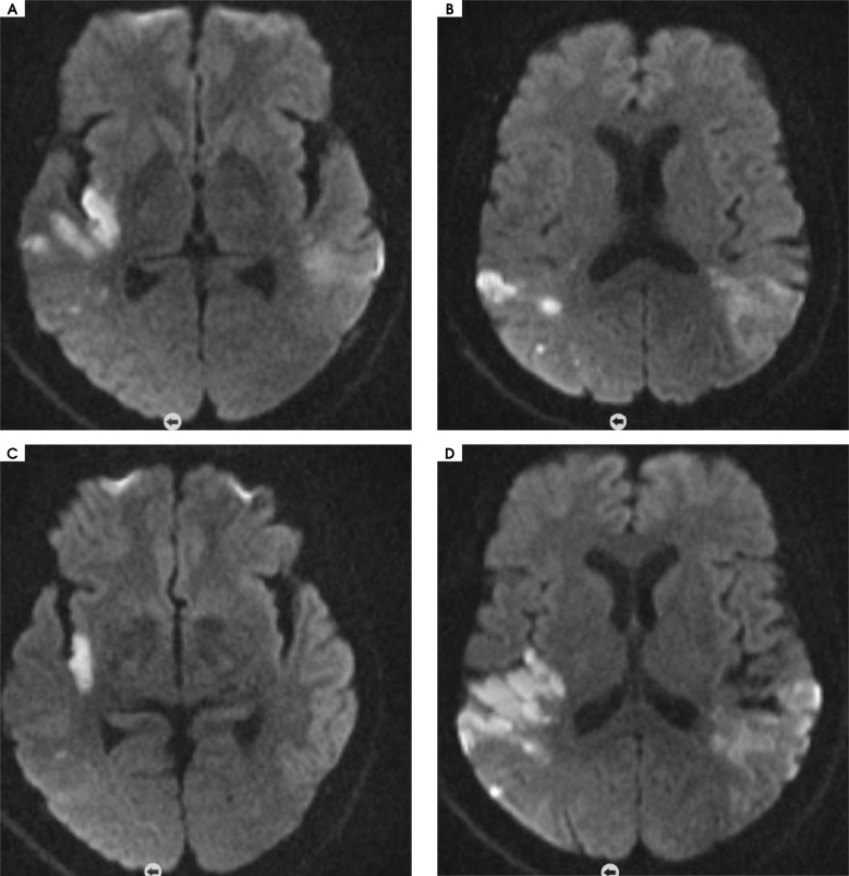Localised scleroderma and ischemic stroke: case report.