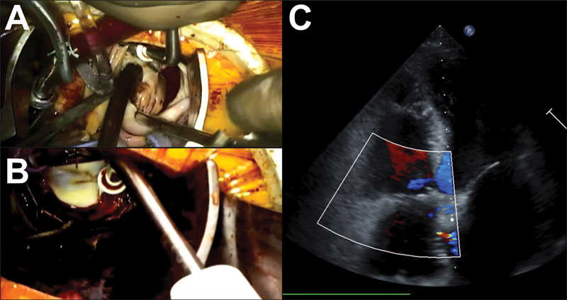 Minimally Invasive Correction of Failed Percutaneous Atrial Septal Closure with Device Embolization.