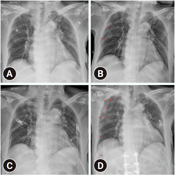 Misinterpretation of a skin fold artifact as pneumothorax on the chest x-ray of a trauma patient in Korea: a case report.