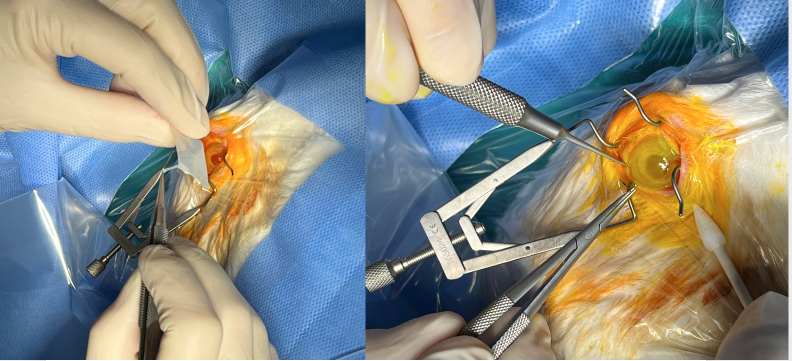 Clinically correlated dose of the amniotic membrane extract is superior to its transplantation in corneal wound healing.