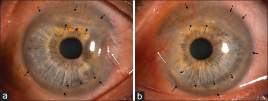 Systemic treatment and surgical intervention in inflammatory Terrien disease.