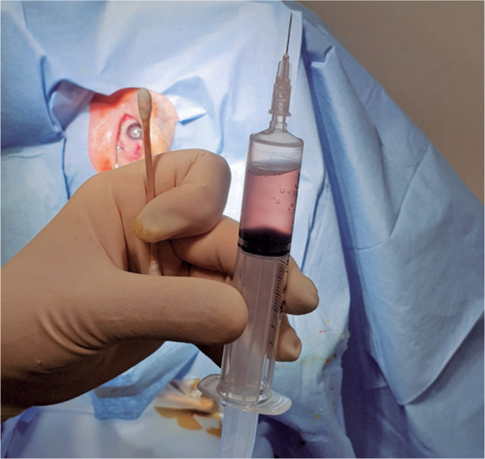 Results of office-based fluid-air exchange for postvitrectomy hemorrhage in diabetic retinopathy.