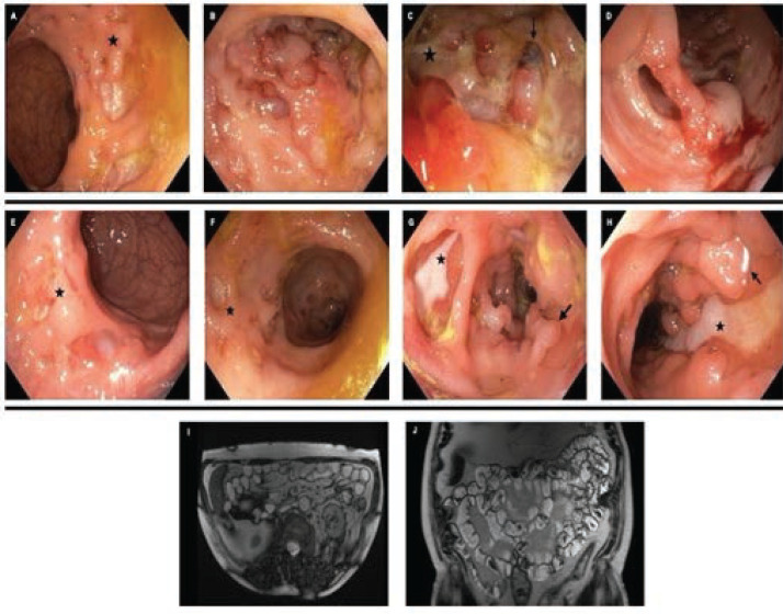 New-Onset, Treatment-Resistant Inflammatory Bowel Disease after Administration of Secukinumab for Plaque Psoriasis: A Case Report and Review of the Existing Literature.