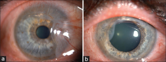 Systemic treatment and surgical intervention in inflammatory Terrien disease.