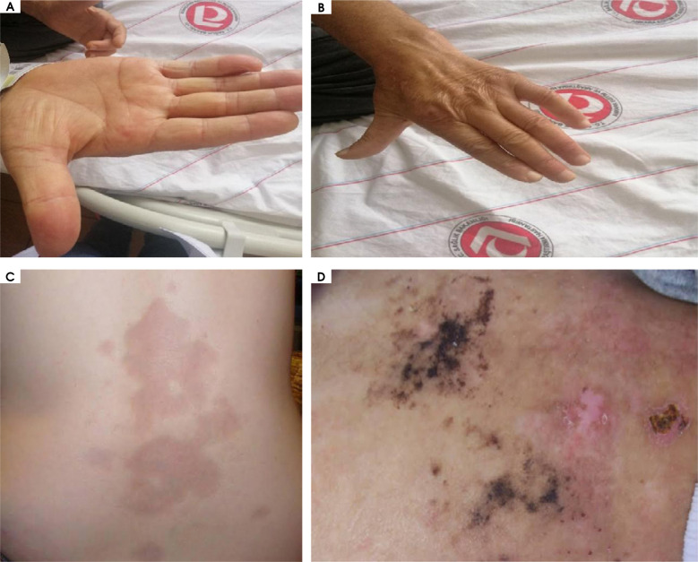 Localised scleroderma and ischemic stroke: case report.