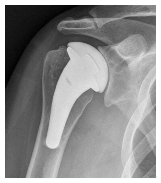 Pyrocarbon hemiarthroplasty and the shoulder: biomechanical and clinical results of an emerging treatment option.