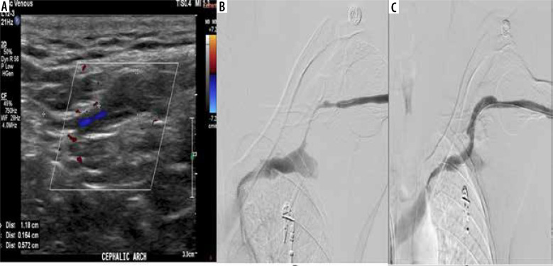 Diagnostic performance and inter-reviewer agreement of colour Doppler ultrasound in haemodialysis fistula and graft complications: a multicentre prospective study.