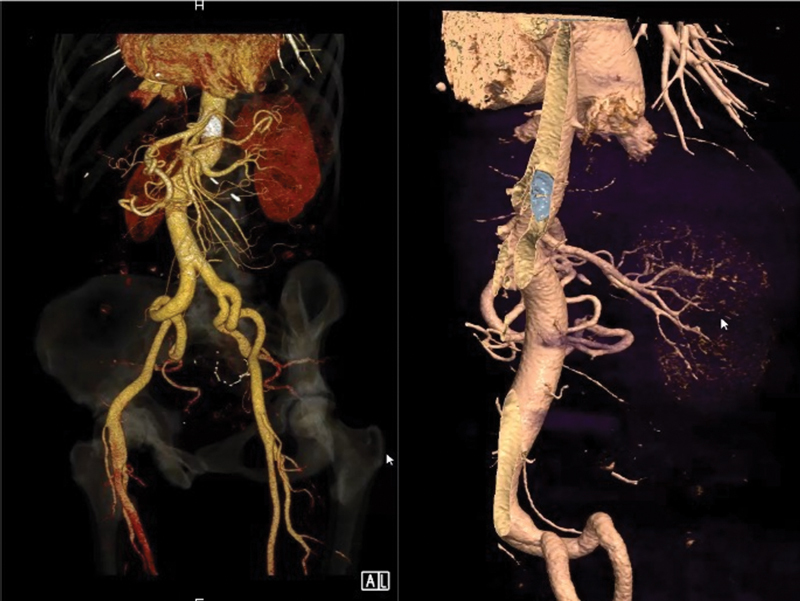 Minimally Invasive Correction of Failed Percutaneous Atrial Septal Closure with Device Embolization.