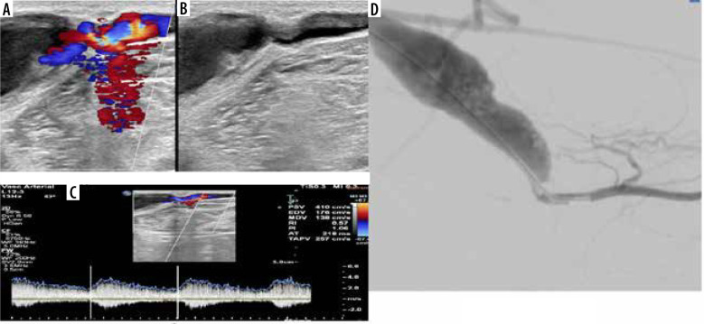 Diagnostic performance and inter-reviewer agreement of colour Doppler ultrasound in haemodialysis fistula and graft complications: a multicentre prospective study.