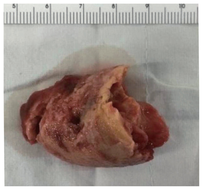 Fibrin-associated large B-cell lymphoma arising in an endovascular graft: first case report in Korea.