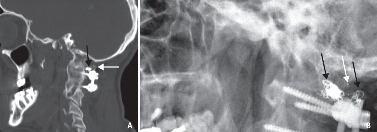 Intrasaccular Flow Disruptor (Woven EndoBridge) Assisted Embolization of Vertebral Arteriovenous Fistulas.