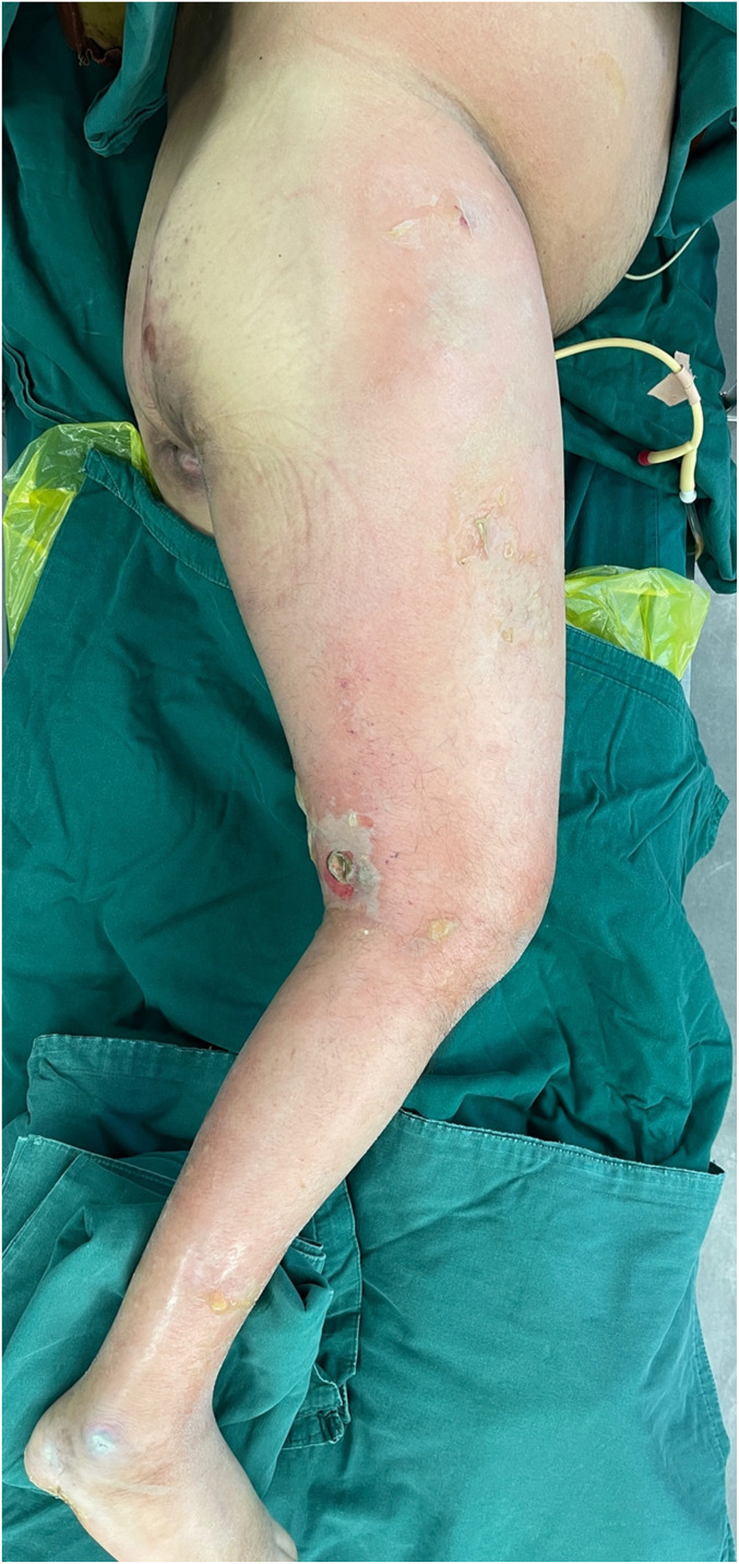 Diagnostic Key Points and Surgical Management of Necrotizing Fasciitis: A Retrospective Study.
