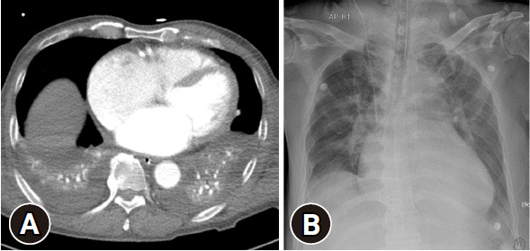 Misinterpretation of a skin fold artifact as pneumothorax on the chest x-ray of a trauma patient in Korea: a case report.