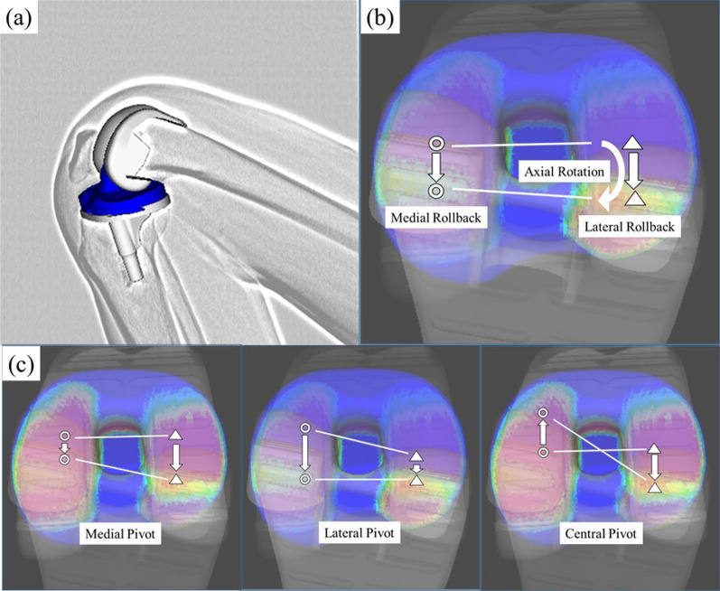 Maximum flexion and lateral rollback revealed better patient satisfaction after total knee arthroplasty.